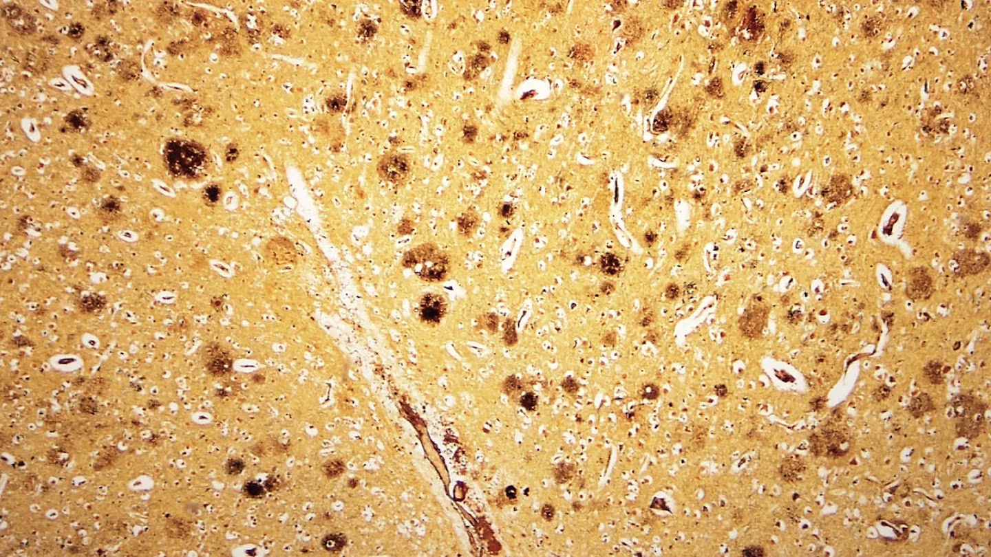 Microscopic view of brain tissue showing numerous amyloid plaques, typical of Alzheimer's disease.
